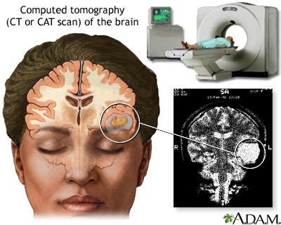 the villages brain ct scan|Computed Tomography (CT or CAT) Scan of the Brain.